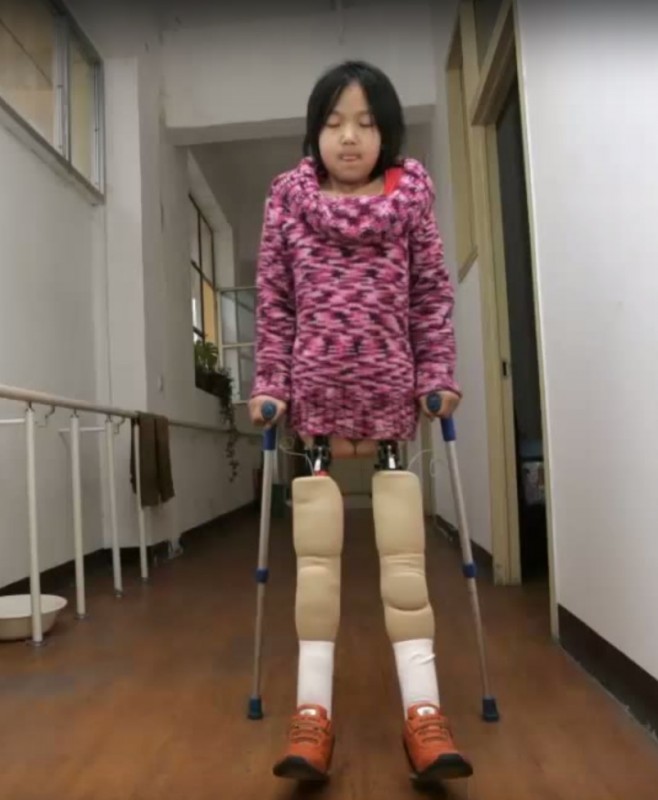 Родилась без ноги. Девушка инвалид. Девушки инвалиды без ног. Дети с ампутированными конечностями.