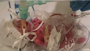 Lekarze ratują przedwcześnie urodzonego noworodka owijając go w reklamówkę po ka