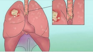 Rak płuc wykryty w porę jest uleczalny! Zobaczcie, jakie daje objawy.