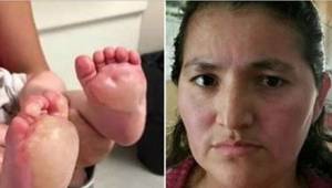 Matka zobaczyła duże pęcherze na stopach swojego dziecka. Lekarze powiedzieli je